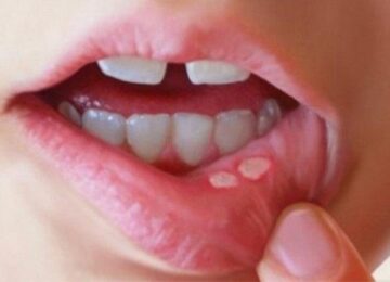 mouth ulcer