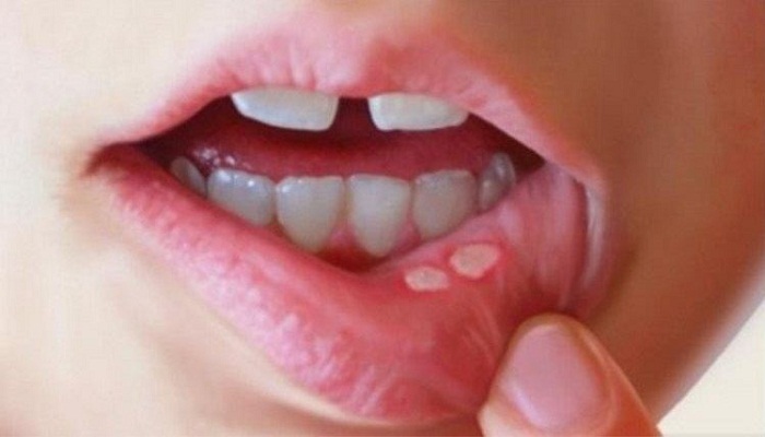 mouth ulcer